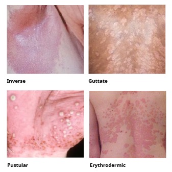 Types of Psoriasis
